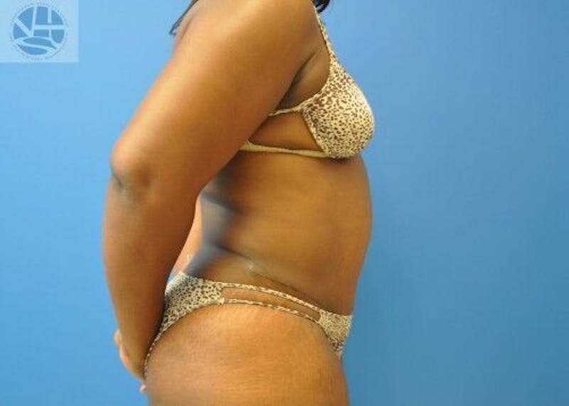 Plus Size Tummy Tuck Before & After Gallery - Patient 702087 - Image 10