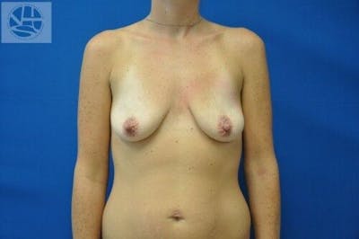 Breast Augmentation with Lift Before & After Gallery - Patient 55345380 - Image 1