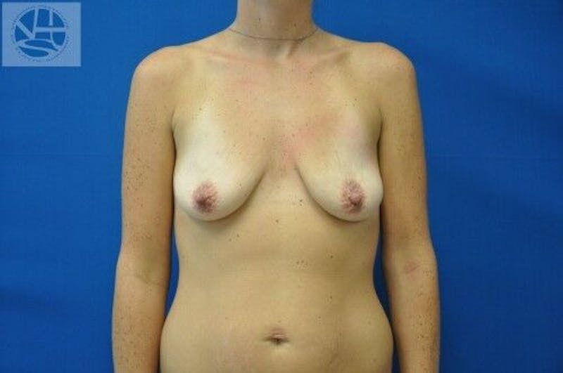 Breast Augmentation with Lift Before & After Gallery - Patient 55345380 - Image 1