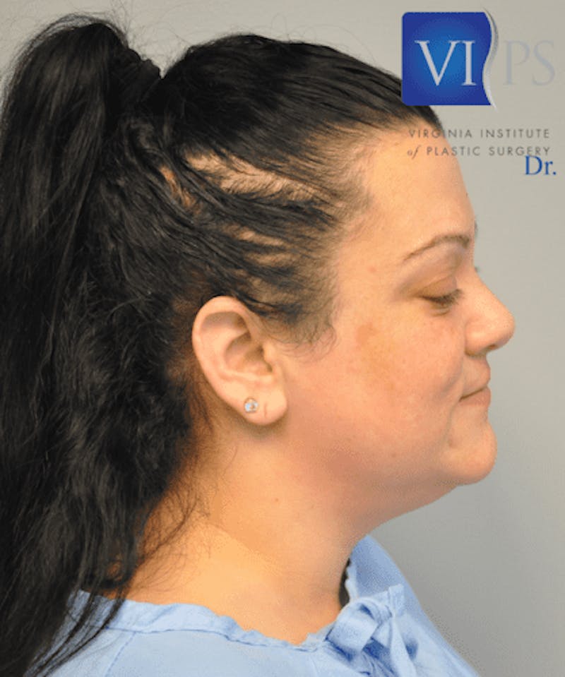 Liposuction Before & After Gallery - Patient 55345375 - Image 5