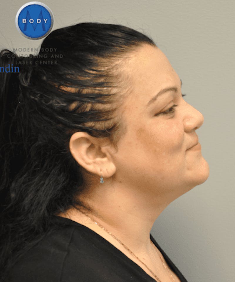 Liposuction Before & After Gallery - Patient 55345375 - Image 6