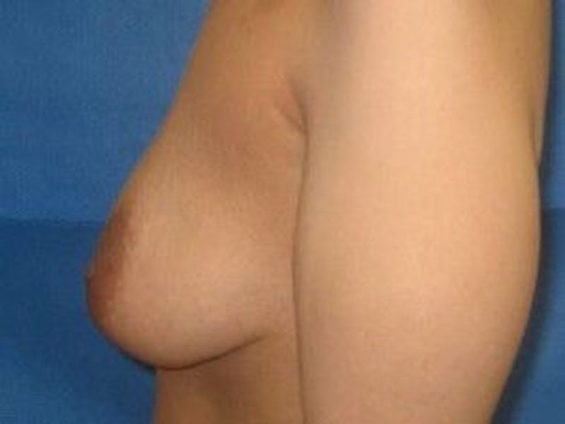 Breast Lift Gallery - Patient 55345374 - Image 7