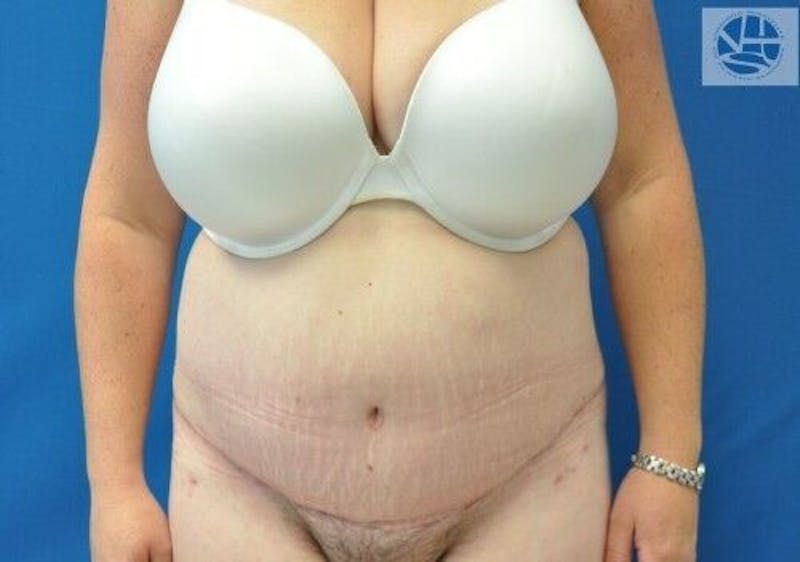 Tummy Tuck Before & After Gallery - Patient 55345381 - Image 2
