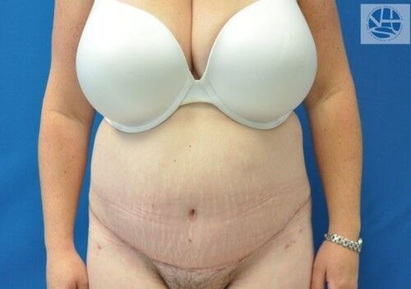 Plus Size Tummy Tuck Before & After Gallery - Patient 287317 - Image 2