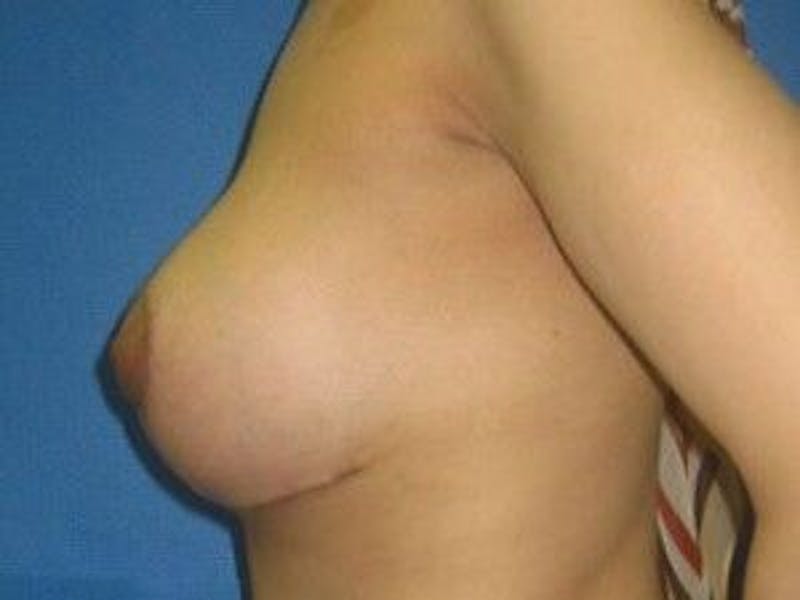 Breast Lift Before & After Gallery - Patient 55345374 - Image 8