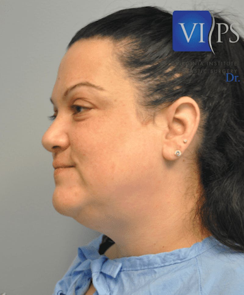 Liposuction Before & After Gallery - Patient 55345375 - Image 7