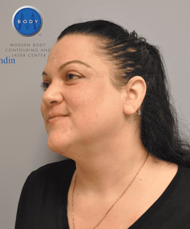 Liposuction Before & After Gallery - Patient 55345375 - Image 8