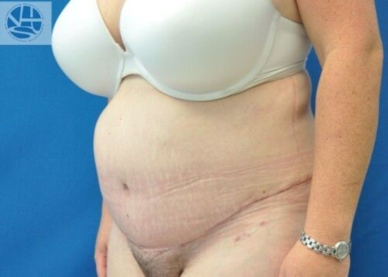 Plus Size Tummy Tuck Before & After Gallery - Patient 287317 - Image 4