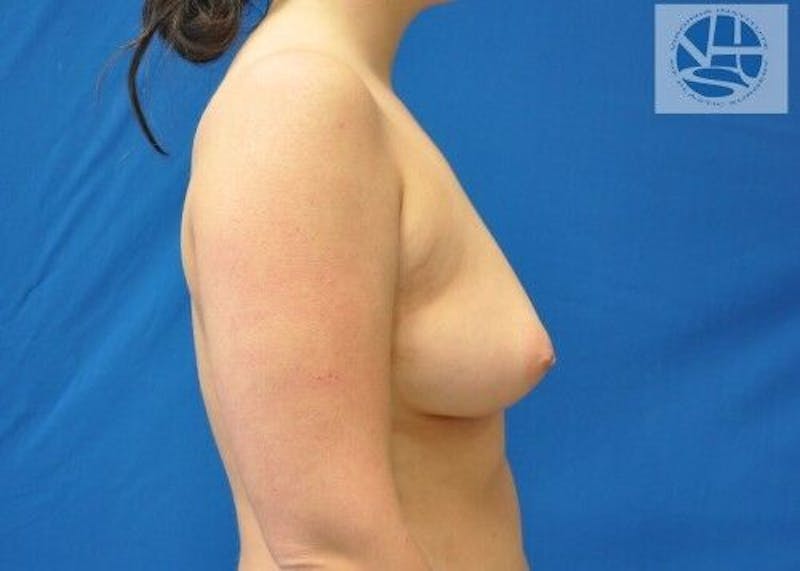 Breast Augmentation Before & After Gallery - Patient 55345377 - Image 7