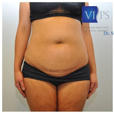 Liposuction Gallery - Patient 55345379 - Image 1