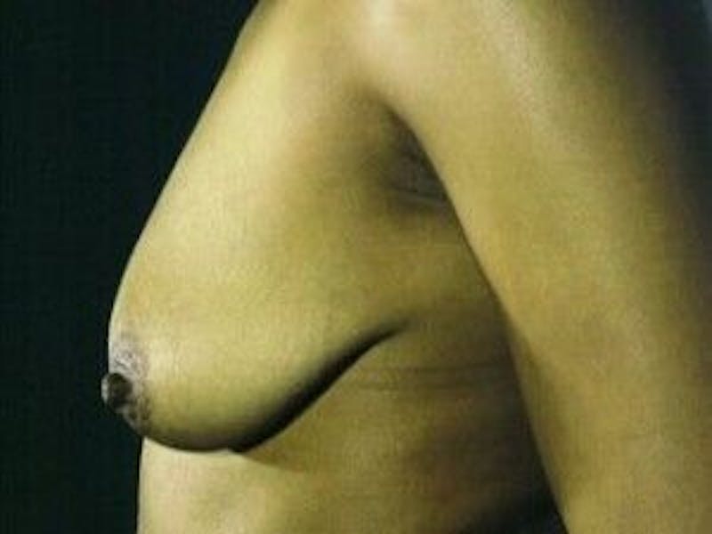 Breast Lift Before & After Gallery - Patient 55345376 - Image 3