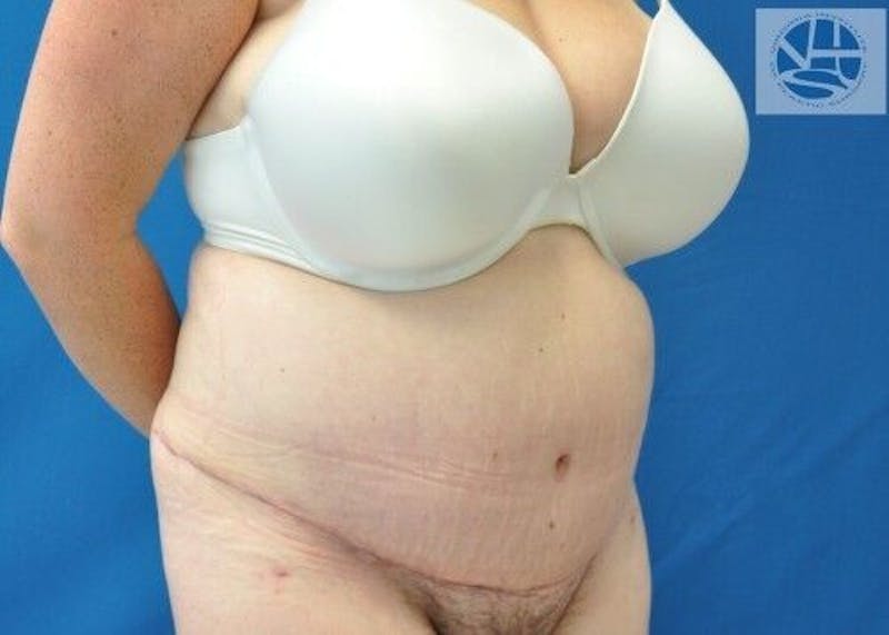 Plus Size Tummy Tuck Before & After Gallery - Patient 287317 - Image 6