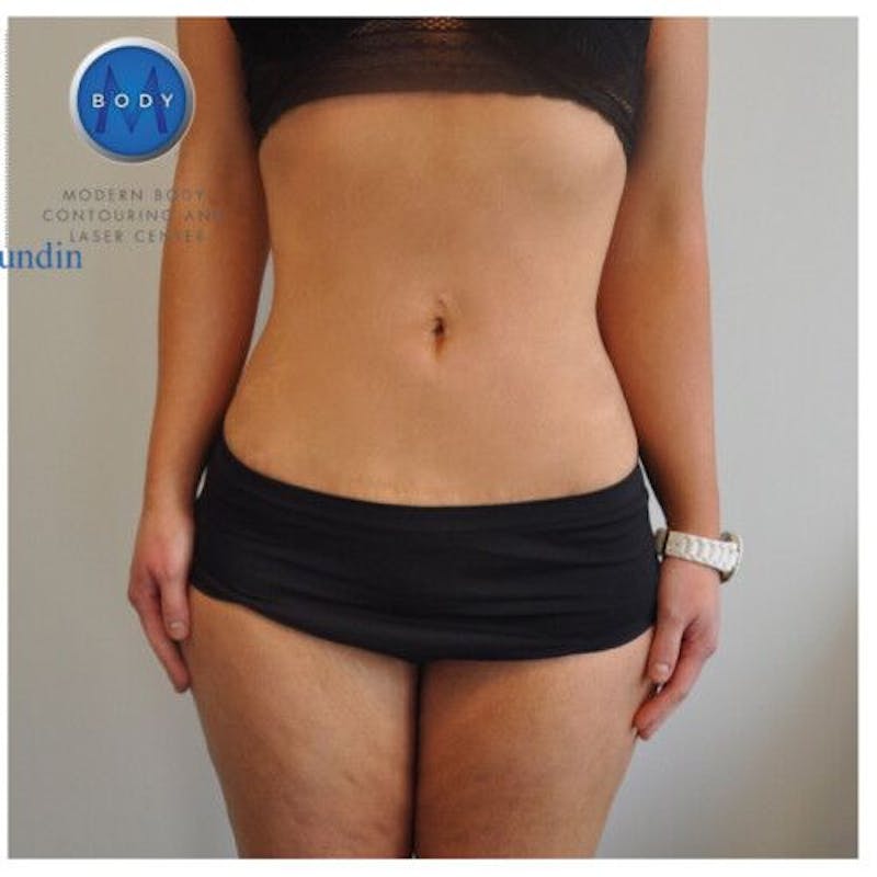 Liposuction Before & After Gallery - Patient 55345379 - Image 2