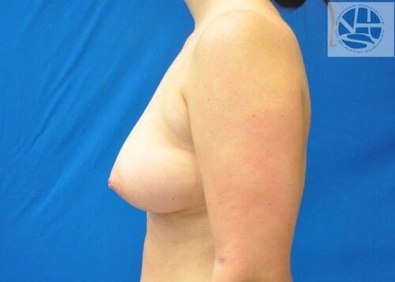 Breast Augmentation Before & After Gallery - Patient 55345377 - Image 9