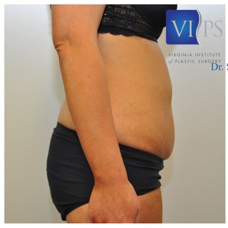 Renuvion J-Plasma Before & After Gallery - Patient 211876539 - Image 3