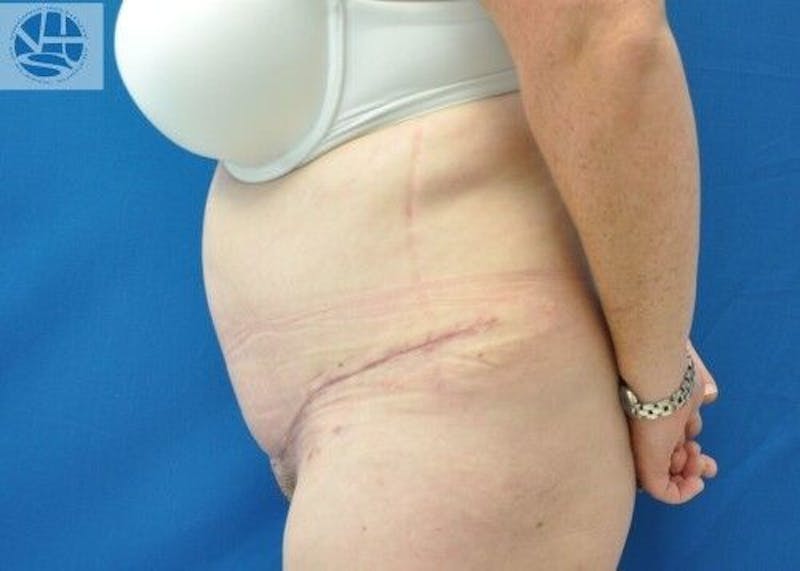 Tummy Tuck Before & After Gallery - Patient 55345381 - Image 8