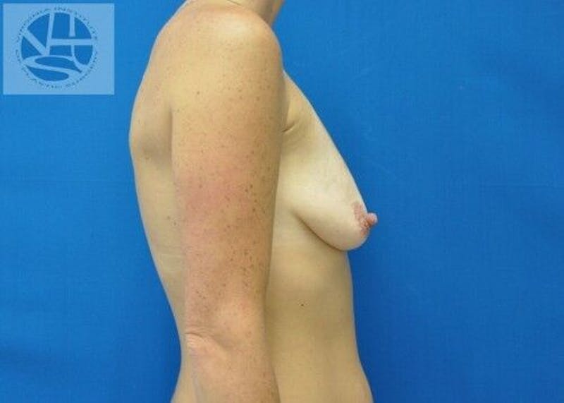Breast Augmentation with Lift Before & After Gallery - Patient 55345380 - Image 9