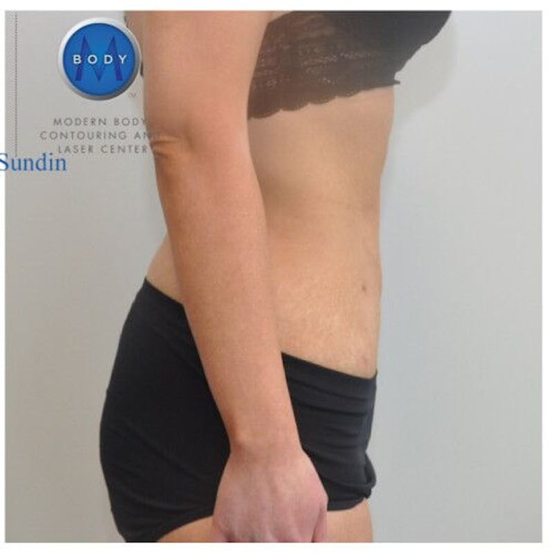 Liposuction Before & After Gallery - Patient 211876594 - Image 4