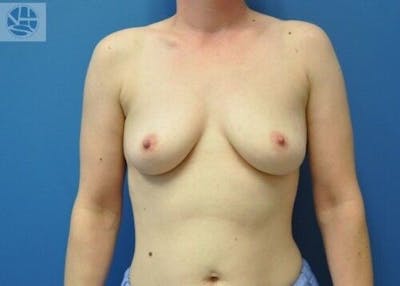 Breast Augmentation Before & After Gallery - Patient 55345384 - Image 1