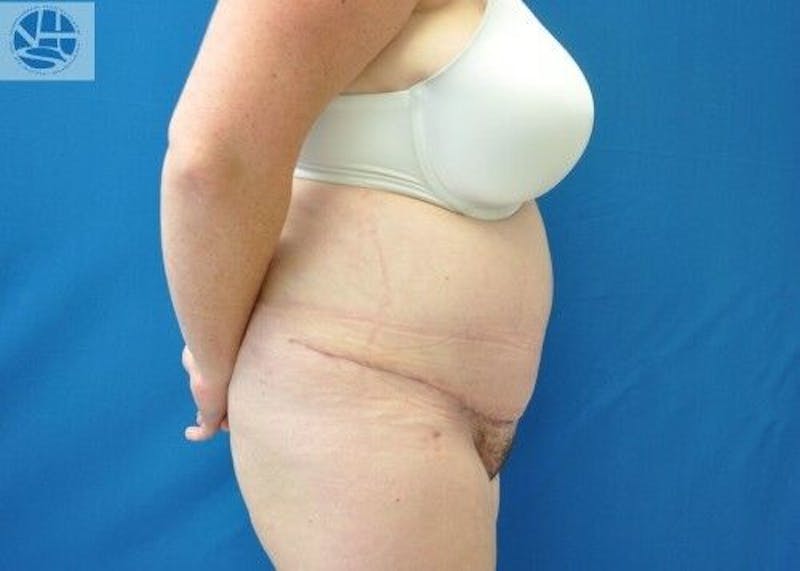 Plus Size Tummy Tuck Before & After Gallery - Patient 287317 - Image 10