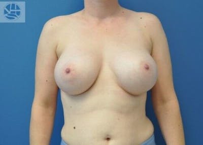 Breast Augmentation Before & After Gallery - Patient 55345384 - Image 2