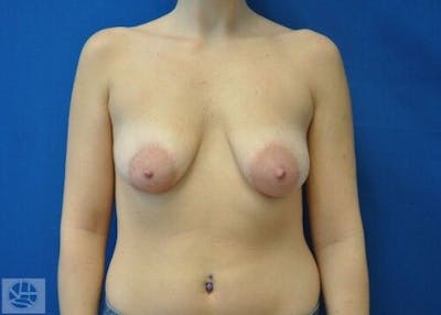 Breast Augmentation with Lift Before & After Gallery - Patient 55345382 - Image 1