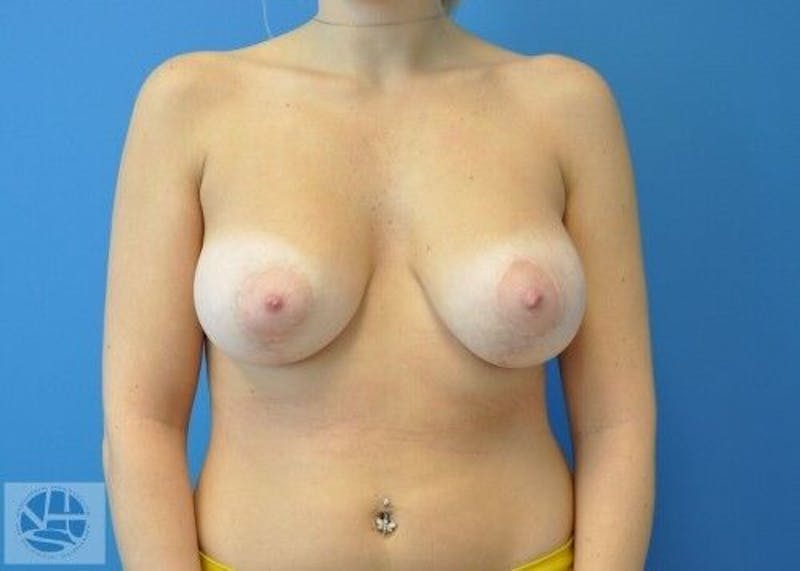 Breast Augmentation with Lift Before & After Gallery - Patient 55345382 - Image 2
