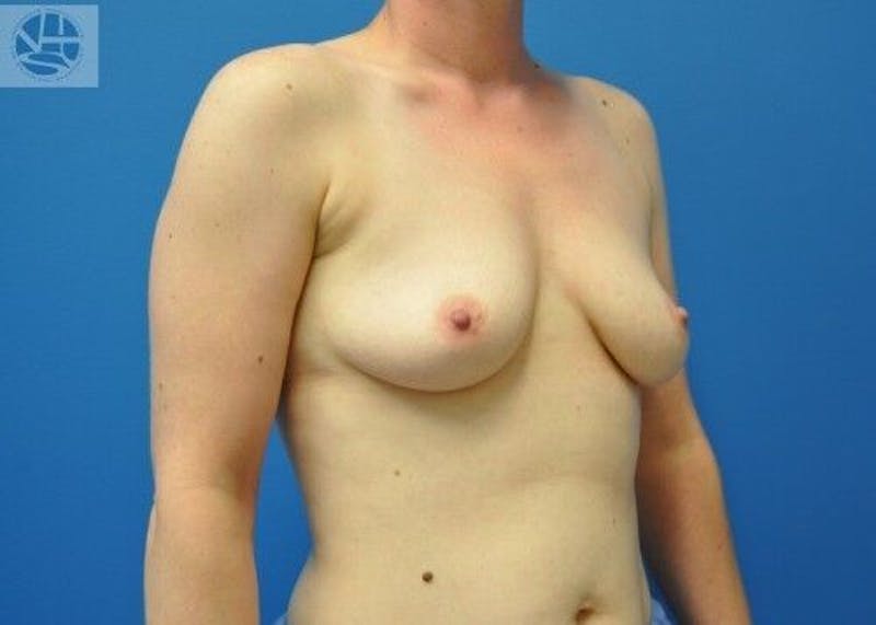 Breast Augmentation Before & After Gallery - Patient 55345384 - Image 5