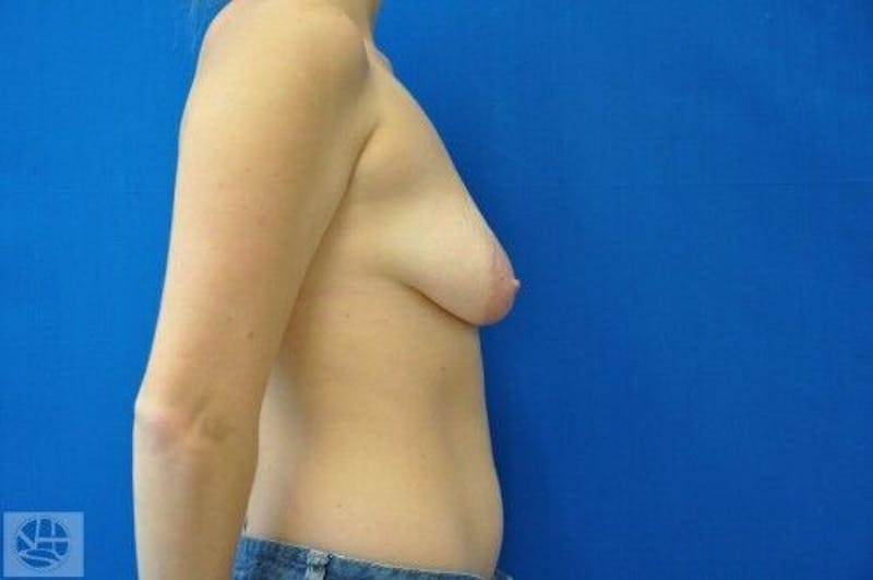 Breast Augmentation with Lift Before & After Gallery - Patient 55345382 - Image 5