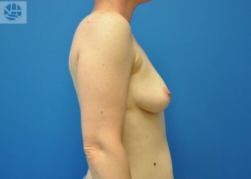 Breast Augmentation Before & After Gallery - Patient 55345384 - Image 7