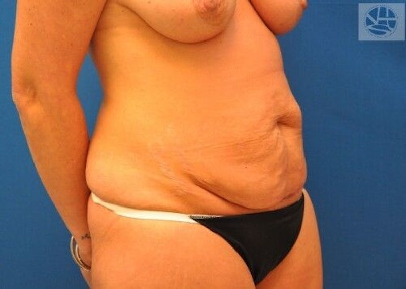Tummy Tuck Before & After Gallery - Patient 55345386 - Image 5