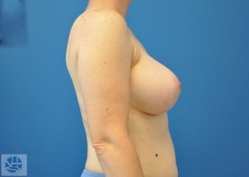 Breast Augmentation Before & After Gallery - Patient 55345384 - Image 8