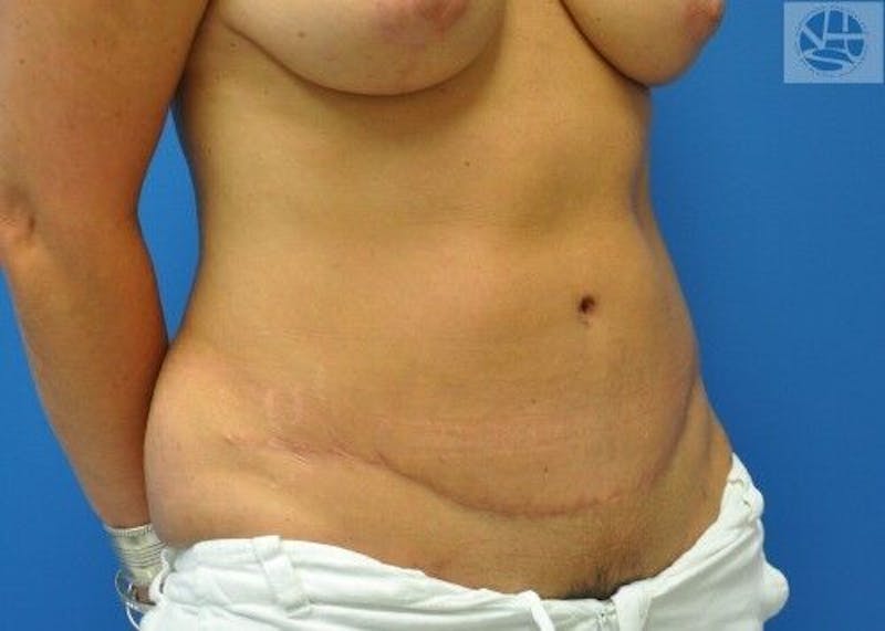 Tummy Tuck Before & After Gallery - Patient 55345386 - Image 6