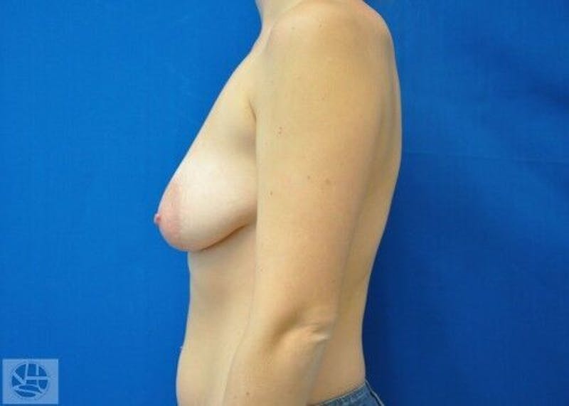 Breast Augmentation with Lift Before & After Gallery - Patient 55345382 - Image 7