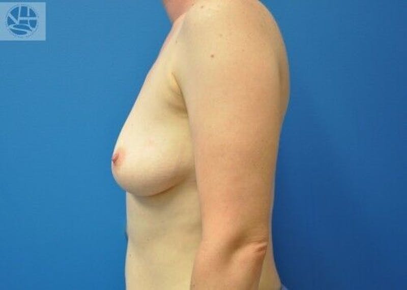 Breast Augmentation Before & After Gallery - Patient 55345384 - Image 9