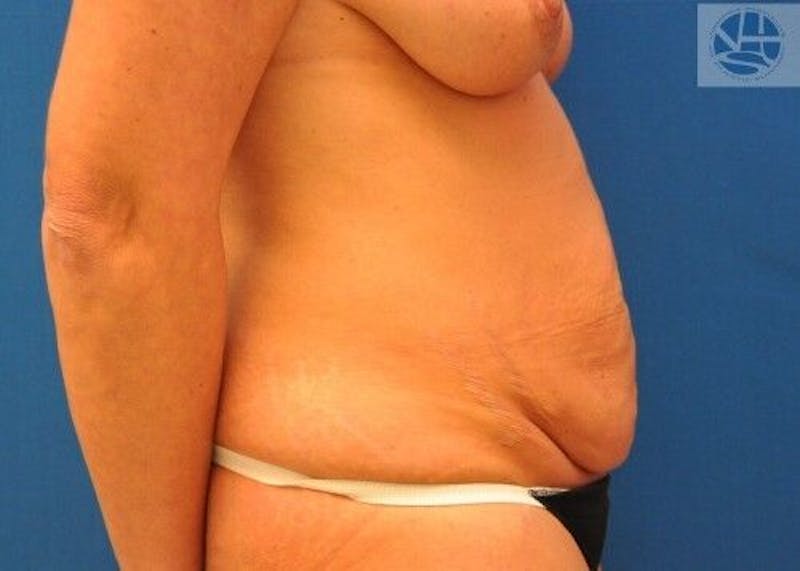 Tummy Tuck Before & After Gallery - Patient 55345386 - Image 7