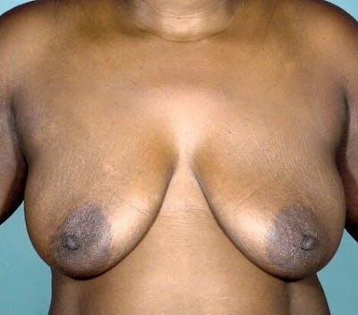 Breast Augmentation with Lift Before & After Gallery - Patient 55345387 - Image 1