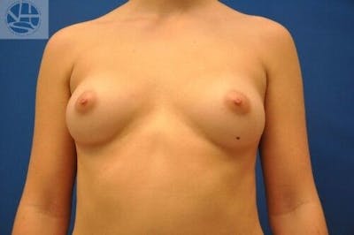 Breast Augmentation Before & After Gallery - Patient 55345388 - Image 1