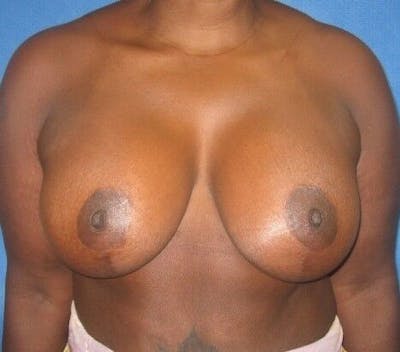 Breast Augmentation with Lift Before & After Gallery - Patient 55345387 - Image 2