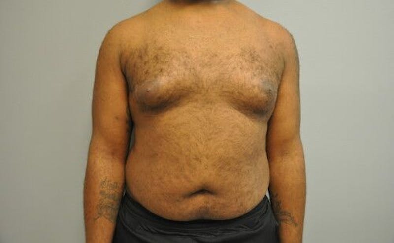 Liposuction Before & After Gallery - Patient 211876595 - Image 1