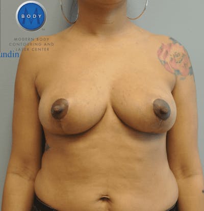 Breast Lift Before & After Gallery - Patient 55345390 - Image 2