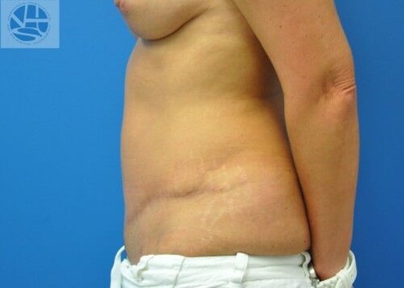 Tummy Tuck Before & After Gallery - Patient 55345386 - Image 10