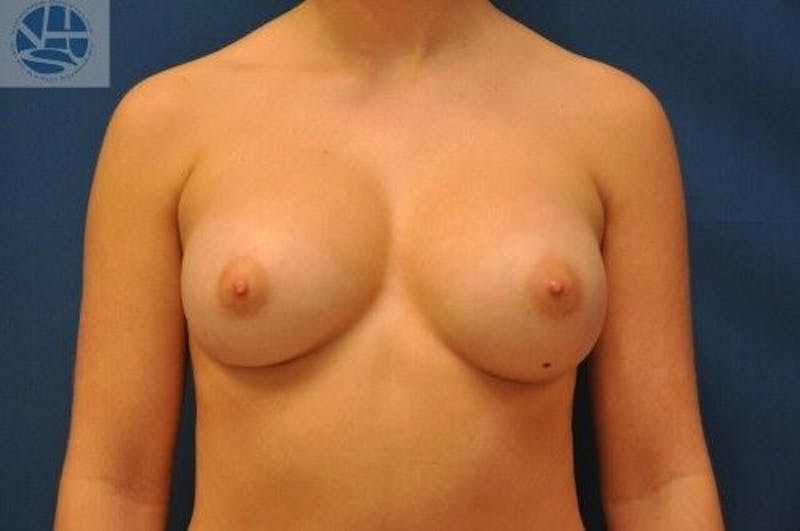 Breast Augmentation Before & After Gallery - Patient 55345388 - Image 2