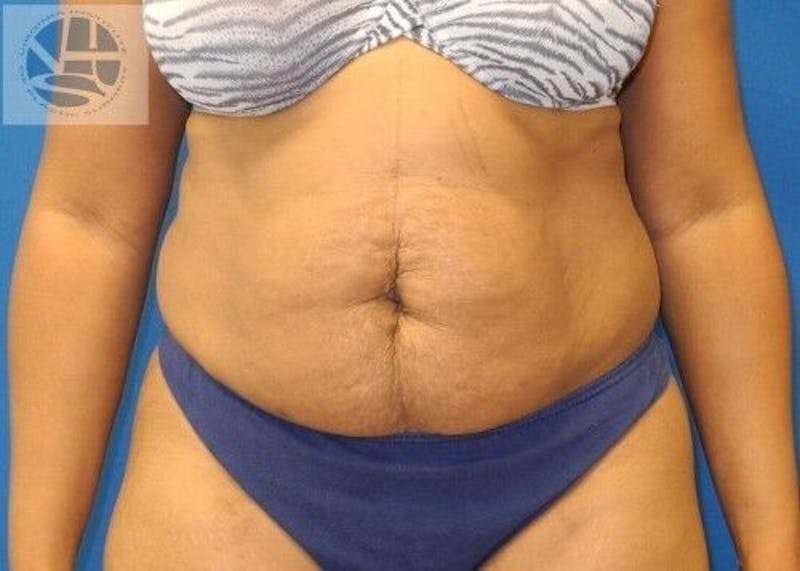 Tummy Tuck Before & After Gallery - Patient 55345392 - Image 1