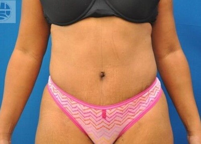 Tummy Tuck Before & After Gallery - Patient 55345392 - Image 2