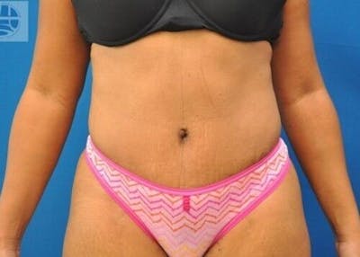 Tummy Tuck Before & After Gallery - Patient 55345392 - Image 2
