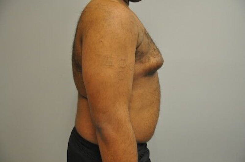 Liposuction Gallery - Patient 55345389 - Image 5