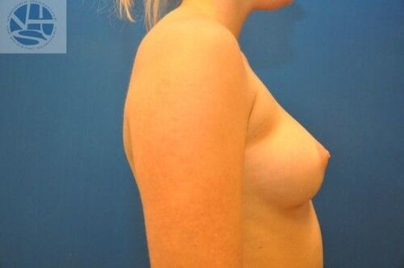 Breast Augmentation Before & After Gallery - Patient 55345388 - Image 7