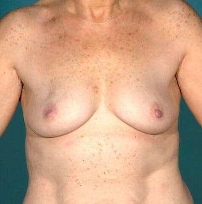Breast Augmentation with Lift Before & After Gallery - Patient 55345391 - Image 1