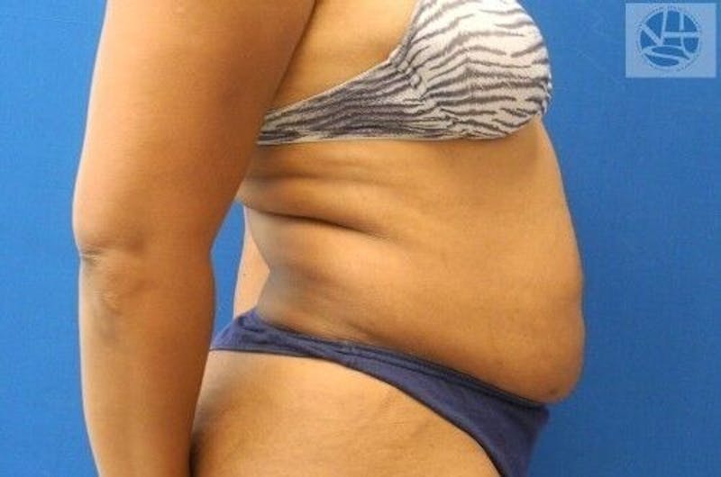 Tummy Tuck Before & After Gallery - Patient 55345392 - Image 5
